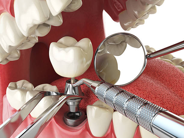 Best Broken or Cracked Tooth Emergency Dentist in Columbia, MS